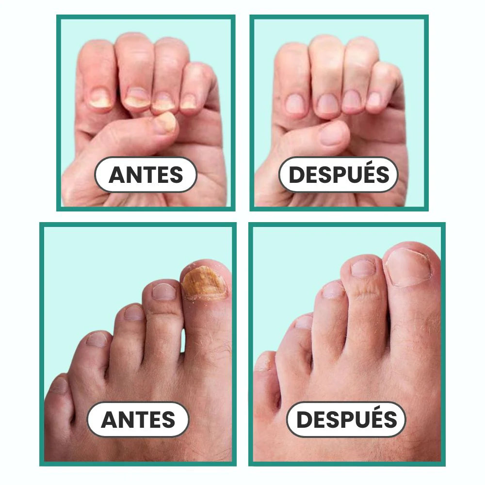 OrthoVital® Solución triple acción —combate, cura y refuerza— para tus uñas